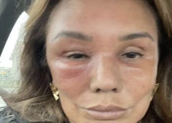 Patty Brard met spoed opgenomen in ziekenhuis: emotionele foto raakt duizenden volgers
